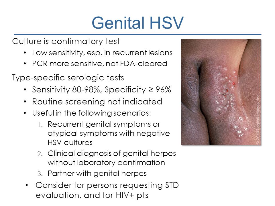 Genital HSV Culture is confirmatory test Type-specific serologic tests.