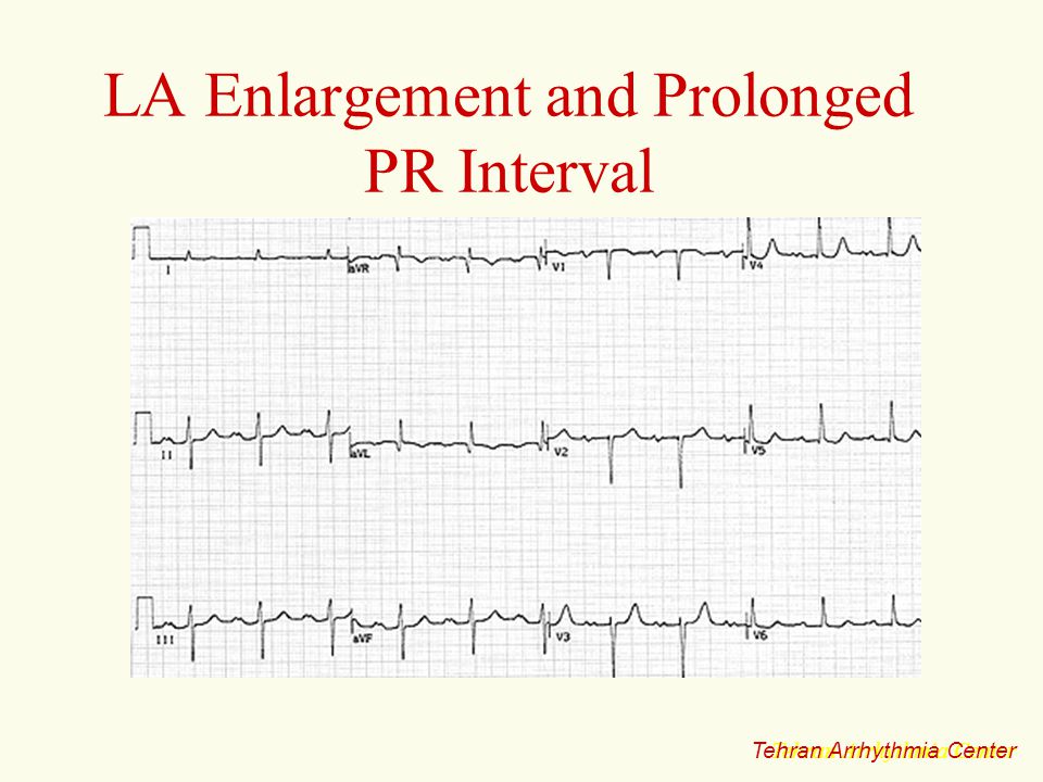 Electrocardiography Cardiac Arrhythmias Ppt Download