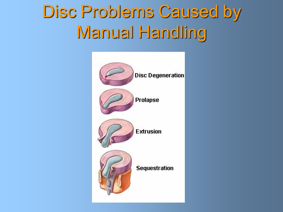 Disc Problems Caused by Manual Handling