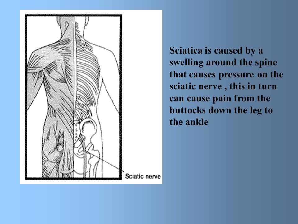 Sciatica is caused by a swelling around the spine that causes pressure on the sciatic nerve , this in turn can cause pain from the buttocks down the leg to the ankle