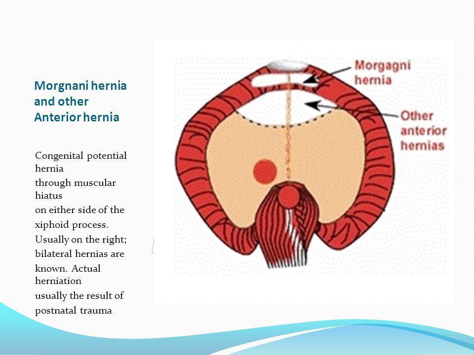 Morgnani hernia and other Anterior hernia