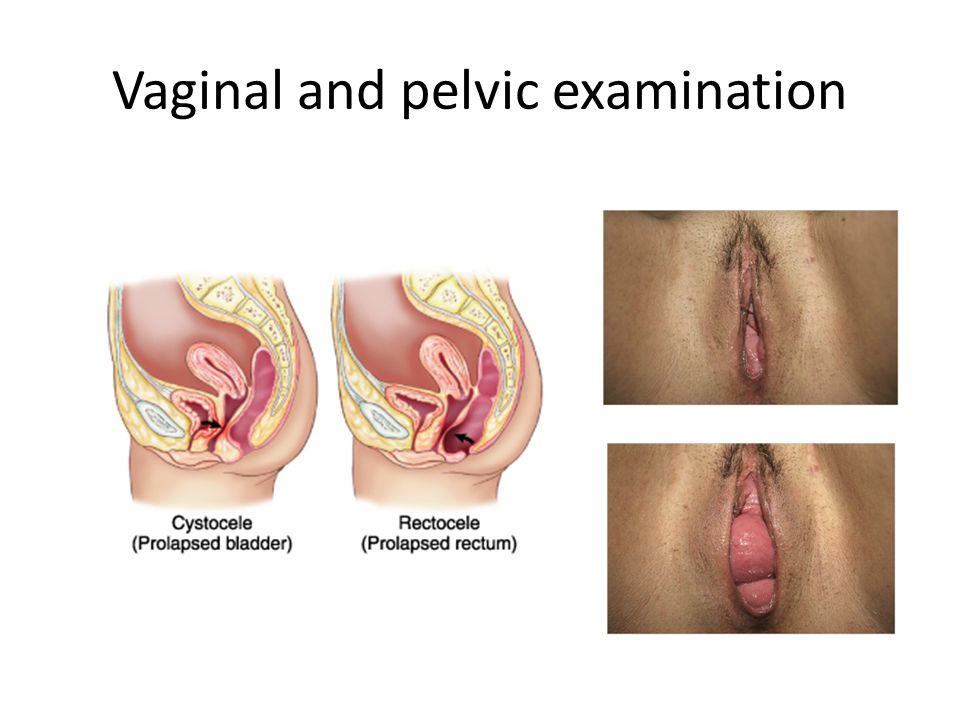 The Ultimate Guide To Vaginal Infections