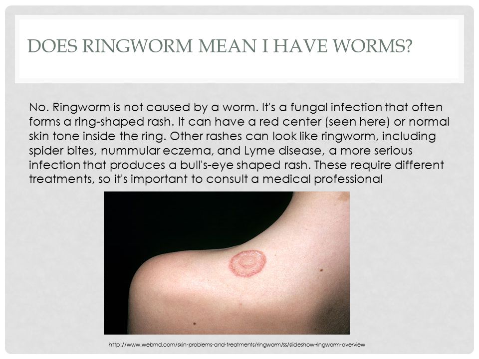 Ringworm - NHS