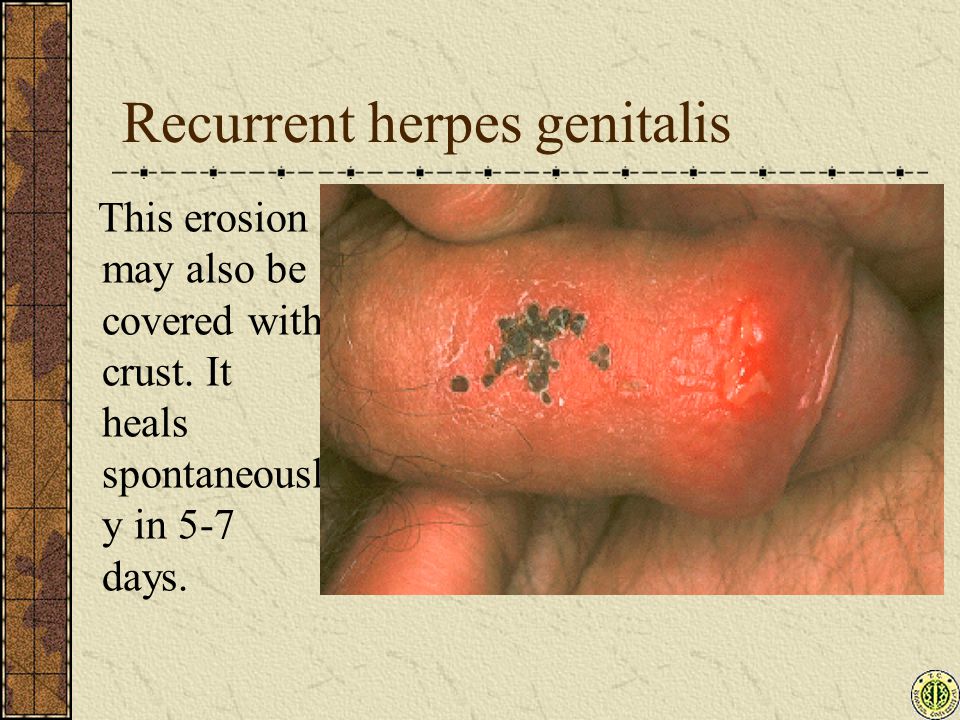 Recurrent herpes genitalis.
