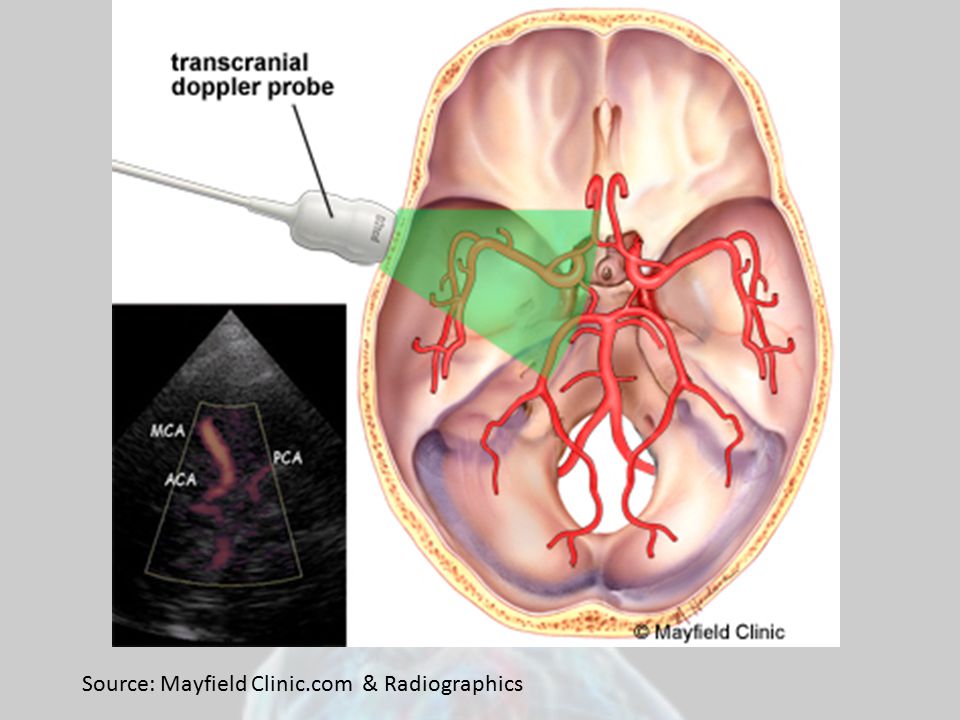Транскраниальных артерий и вен