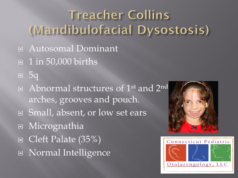 Mandibulofacial Dysostosis Cleft Palate