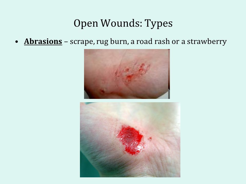 Open Wounds: Types Abrasions - scrape, rug burn, a road rash or a strawberr...
