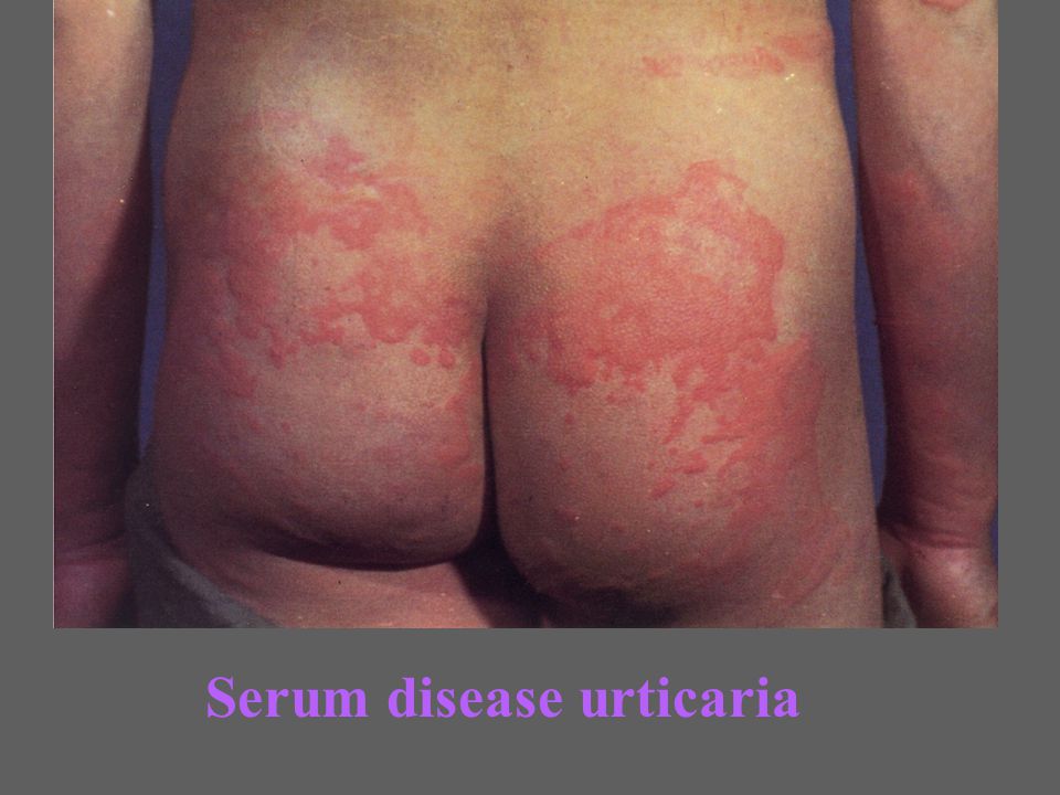 A fertőzések szerepe az akut urticaria kialakulásában