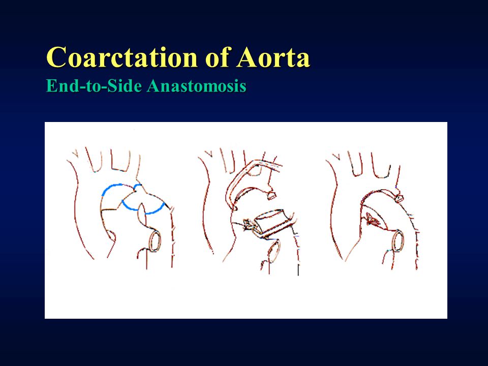 Coarctation of Aorta End-to-Side Anastomosis
