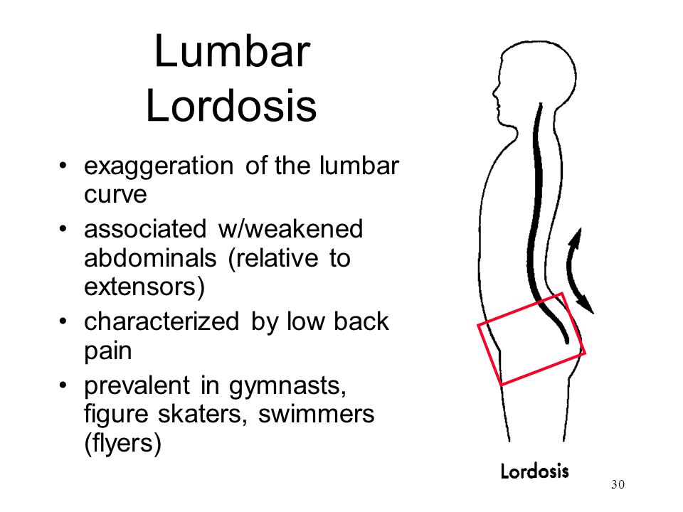 Lumbar Lordosis exaggeration of the lumbar curve.
