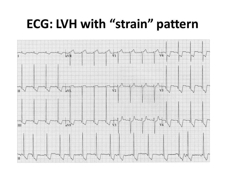 ECG: LVH with strain pattern