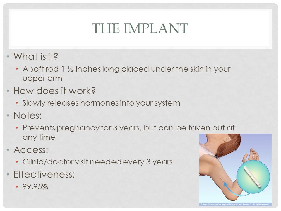 The implant What is it How does it work Notes: Access: