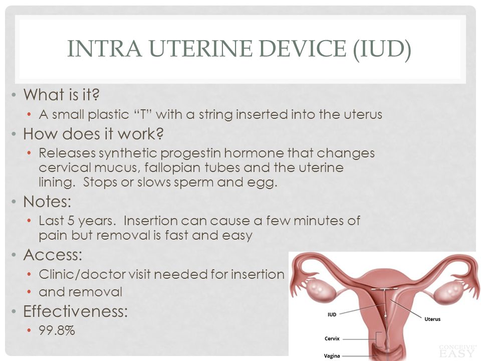 Intra Uterine Device (IUD)