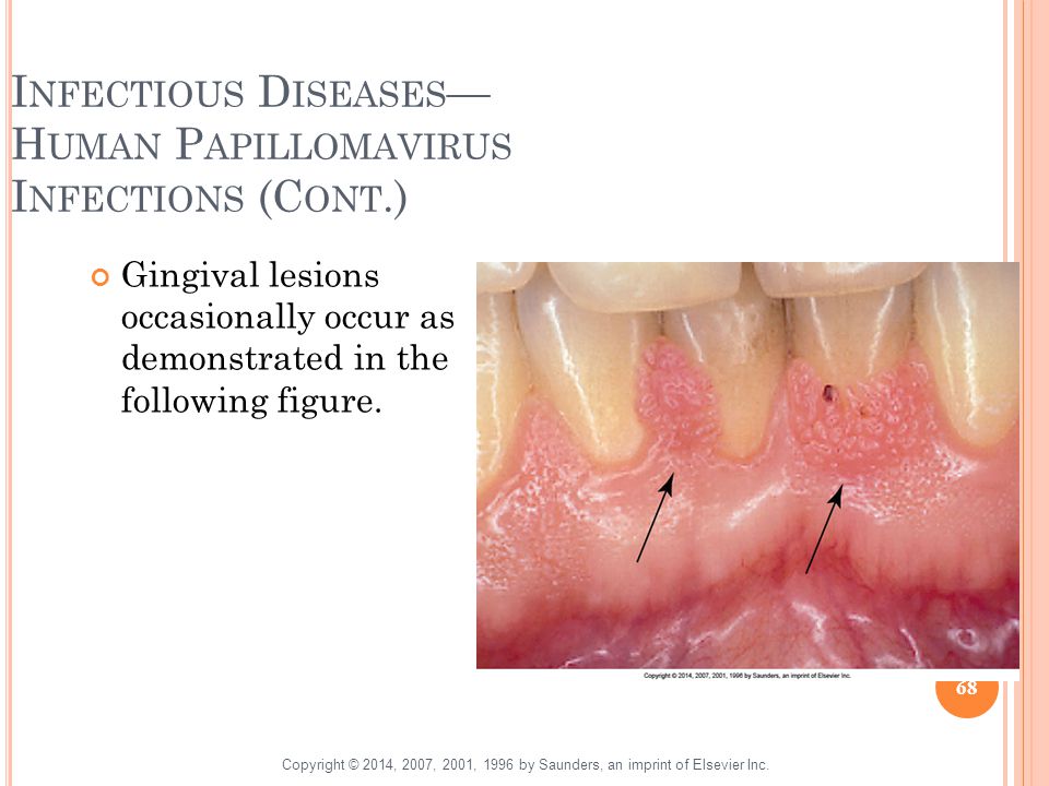 gingival papilloma causes