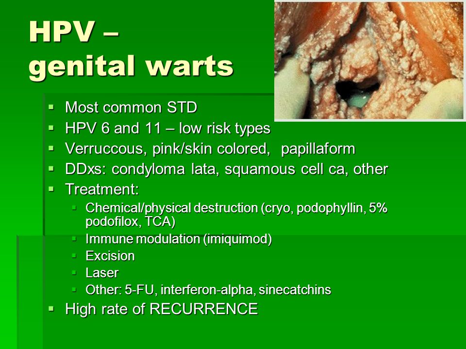 hpv chlamydia definíció hpv és húgycső rák