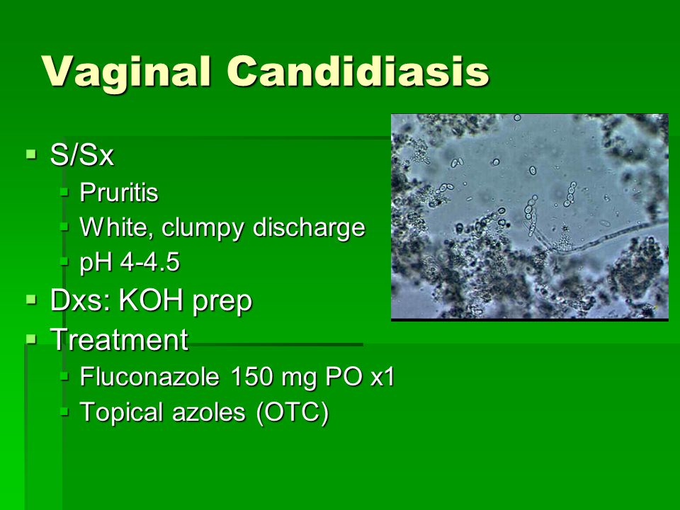 Treatment Options For Acute Vulvovaginal Candidiasis