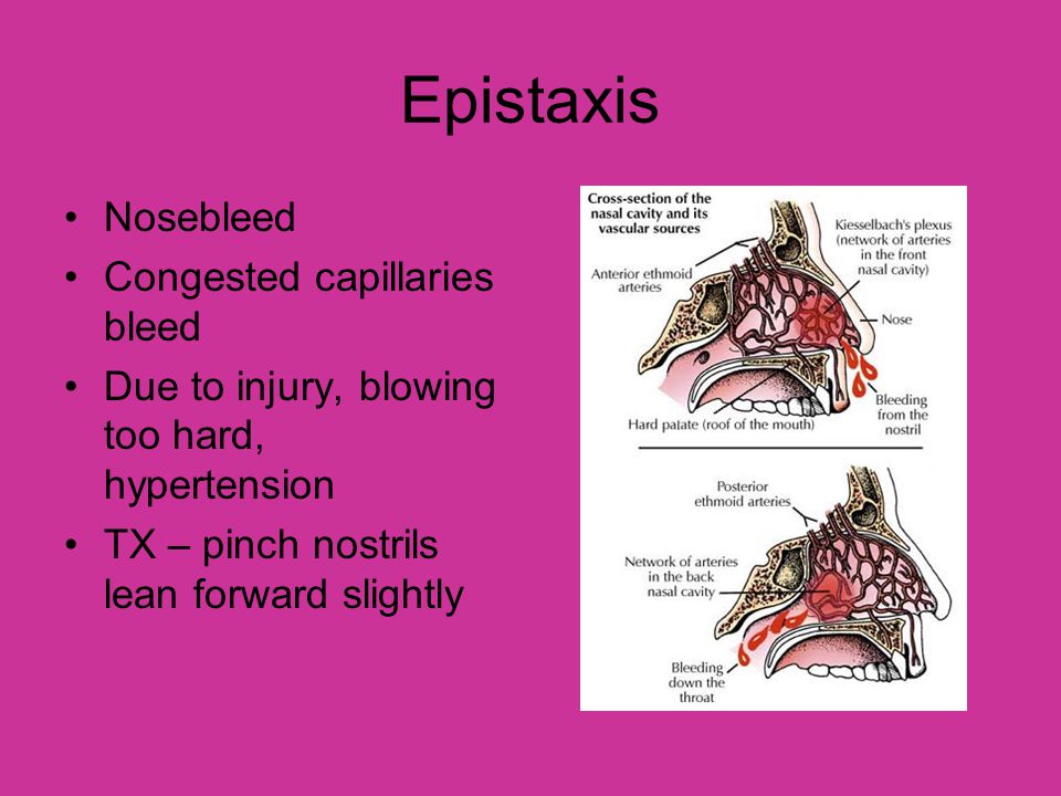 Epistaxis Nosebleed Congested capillaries bleed