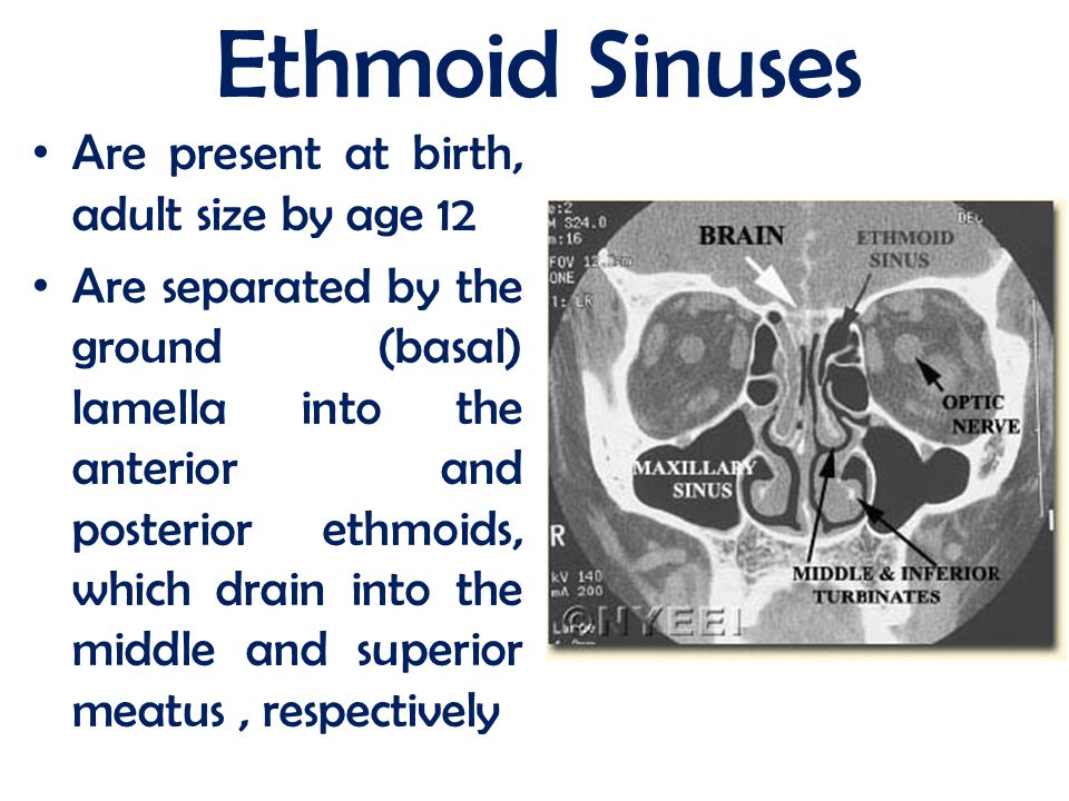 maxillary and ethmoid sinus disease