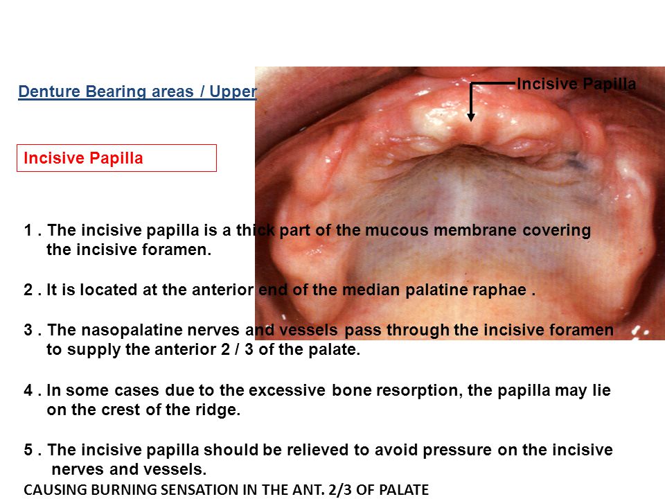 Intra Oral Landmarks Incisive Papilla Denture Bearing areas / Upper.