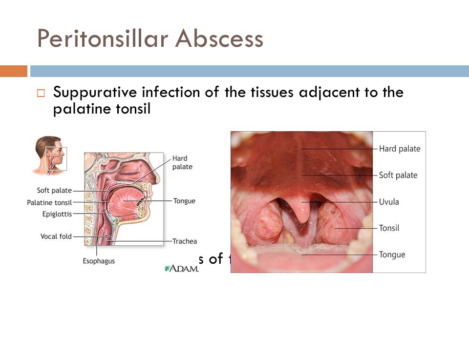 Approach to Sore Throat & Peritonsillar Abscess - ppt video
