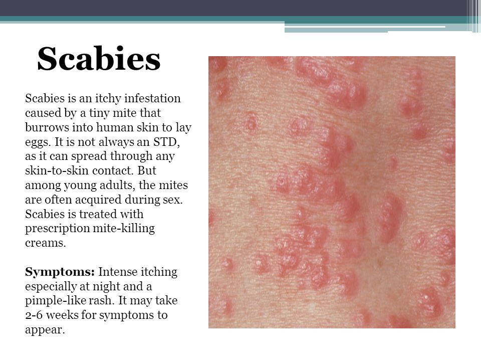 Scabies.