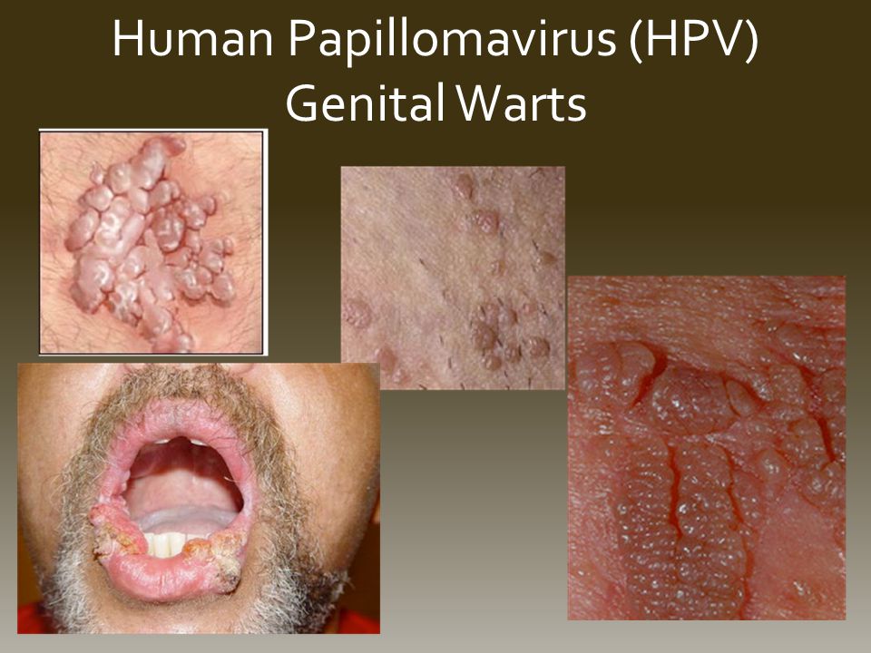 Human Papillomavirus (HPV) Genital Warts.