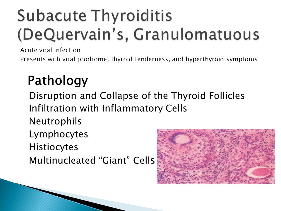 de quervain s thyroiditis pathophysiology fájdalom a bal fenékben az izületek felé sugárzó