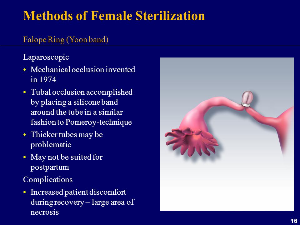EVALUATION OF MINILAP STERILIZATION IN COMPARISON TO LAPAROSCOPIC FALOPE  RING STERILIZATION SUMMARY This is a study of 492 elect