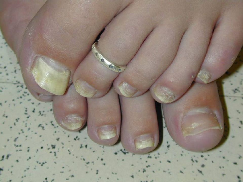 Nail Fungus - Causes, Symptoms and Treatment