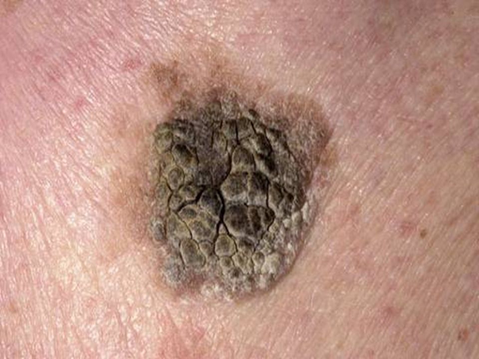 Seborrheic keratosis, a bit more pigmented than the previous one, pigmentation is very common in ALL types of benign keratoses.