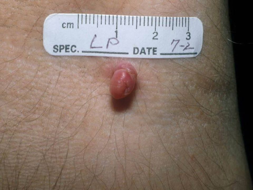 Fibroepithelial polyp, or skin tag