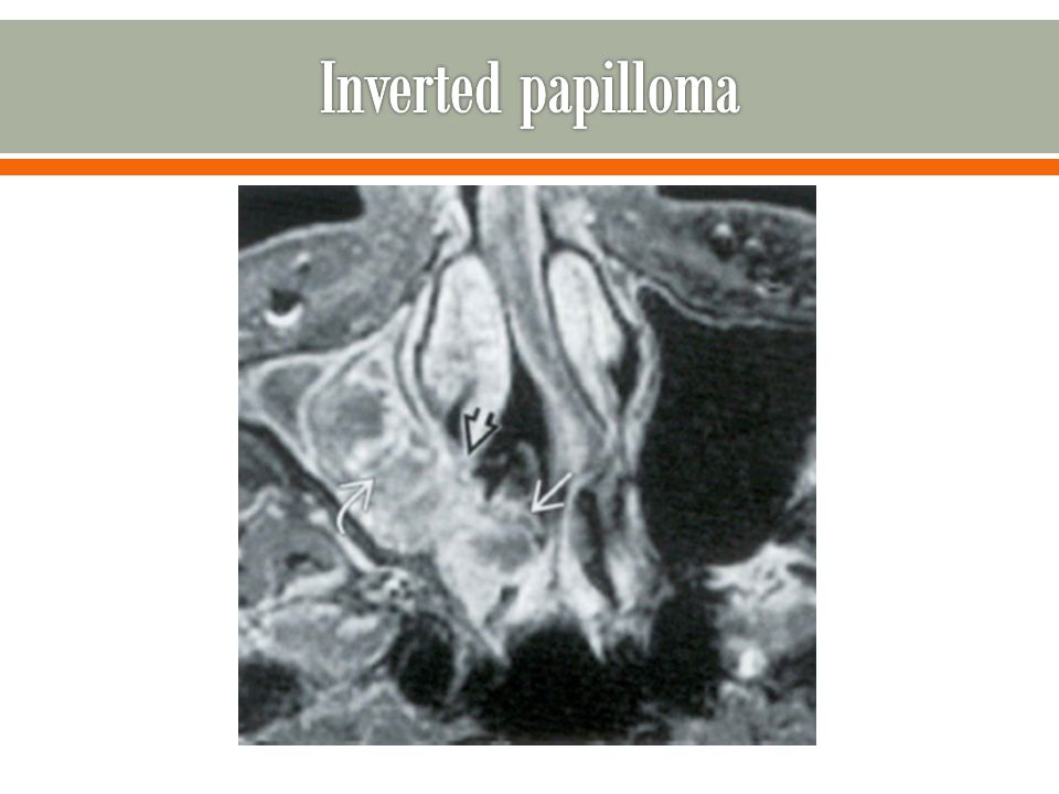 papilloma sinus c2)