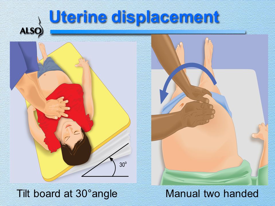 Uterine displacement Tilt board at 30°angle Manual two handed