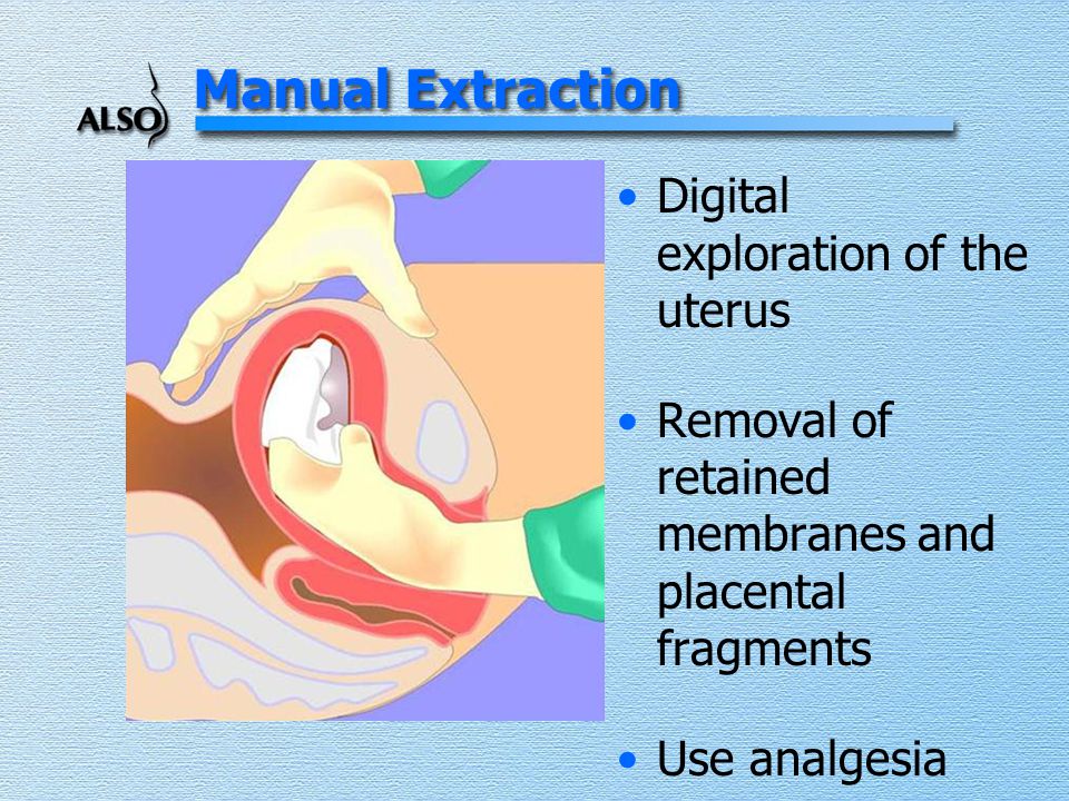Manual Extraction Digital exploration of the uterus