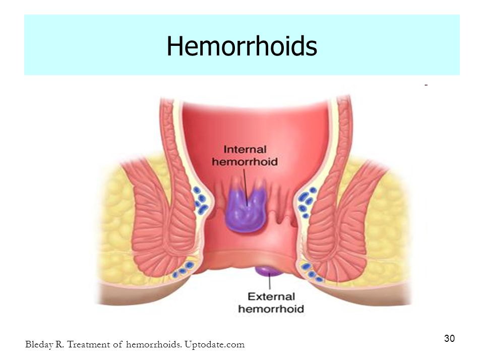 Presentation on theme: "Diverticular Disease and Hemorrhoids"- Pr...