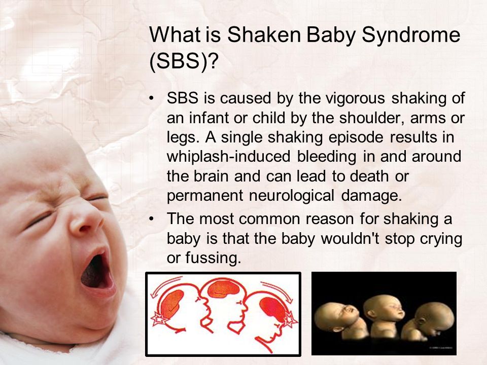 Image result for brain damage shaken baby syndrome
