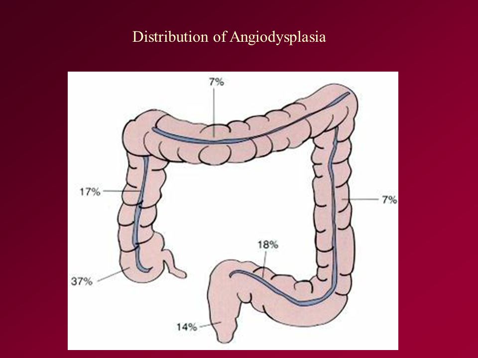 Distribution of Angiodysplasia