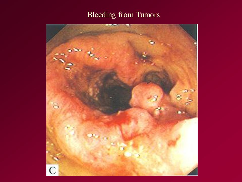 Bleeding from Tumors