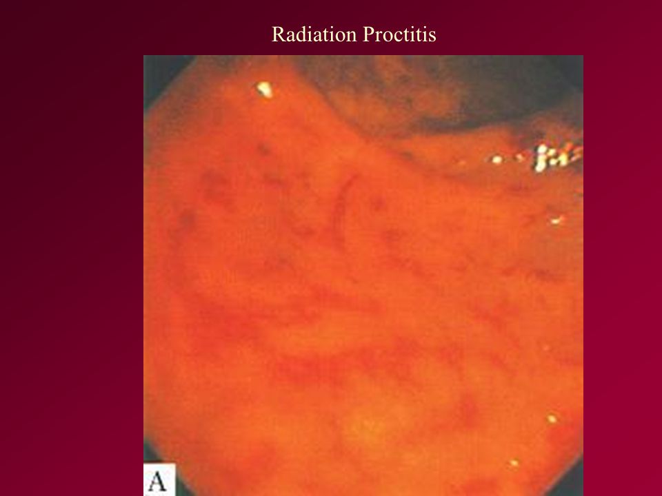 Radiation Proctitis