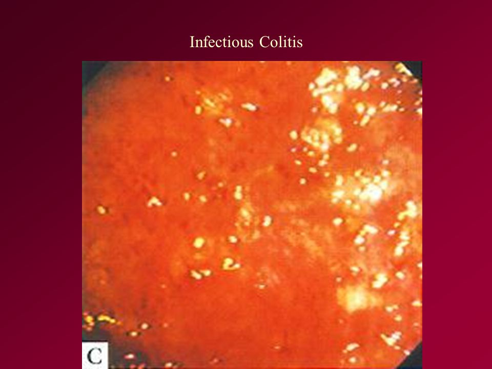 Infectious Colitis