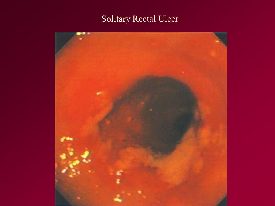 Solitary Rectal Ulcer