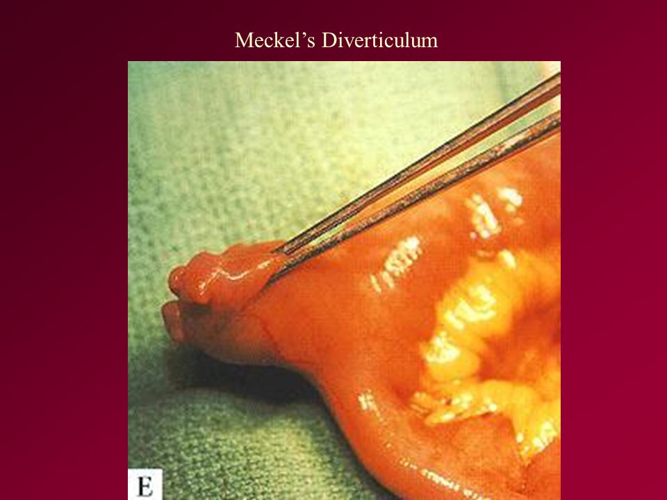 Meckel’s Diverticulum
