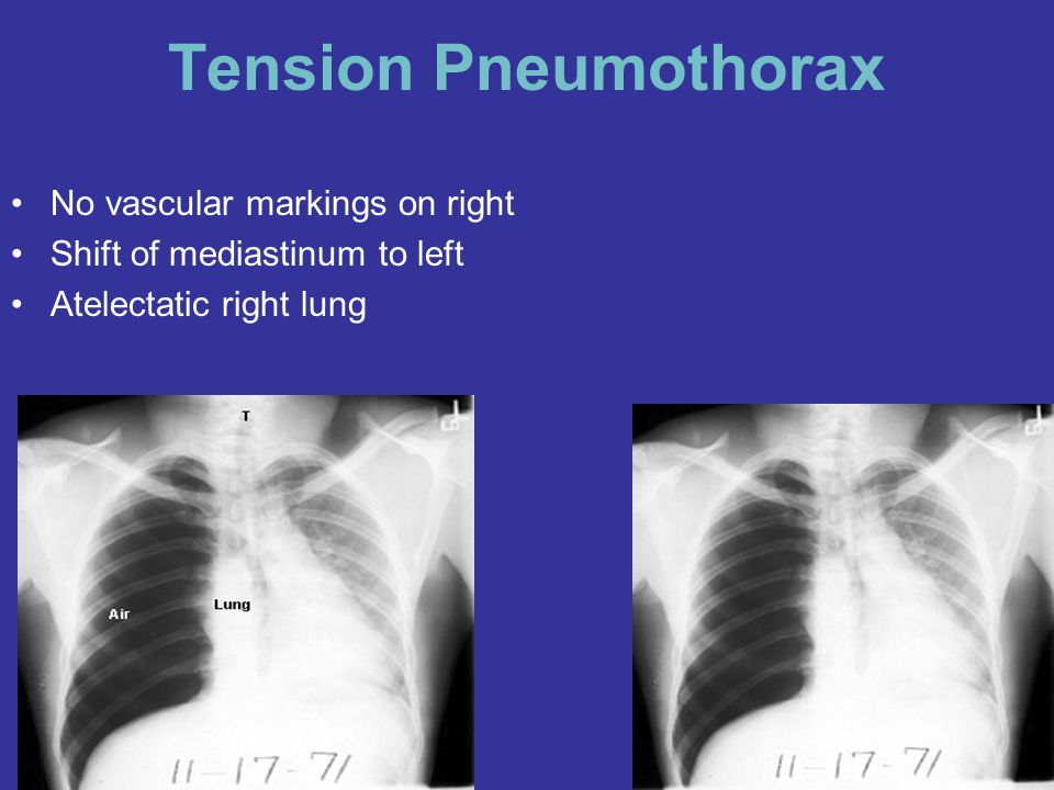 Pneumothorax Ppt Video Online Download