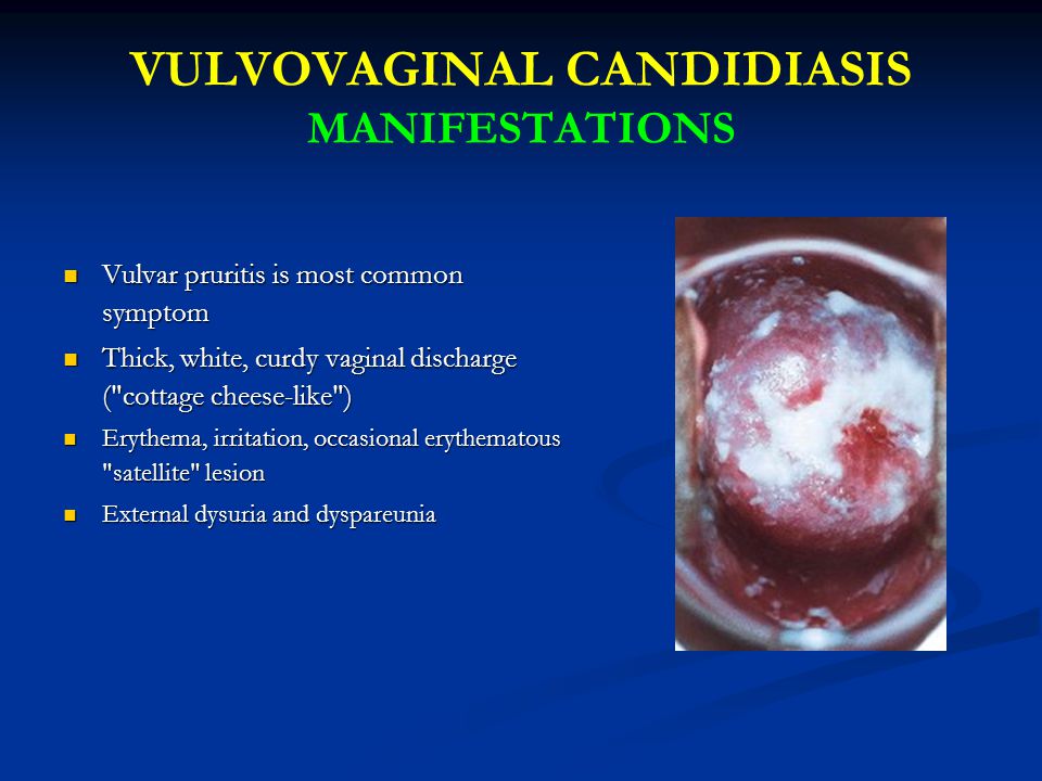 Gynecological Infections Ppt Download