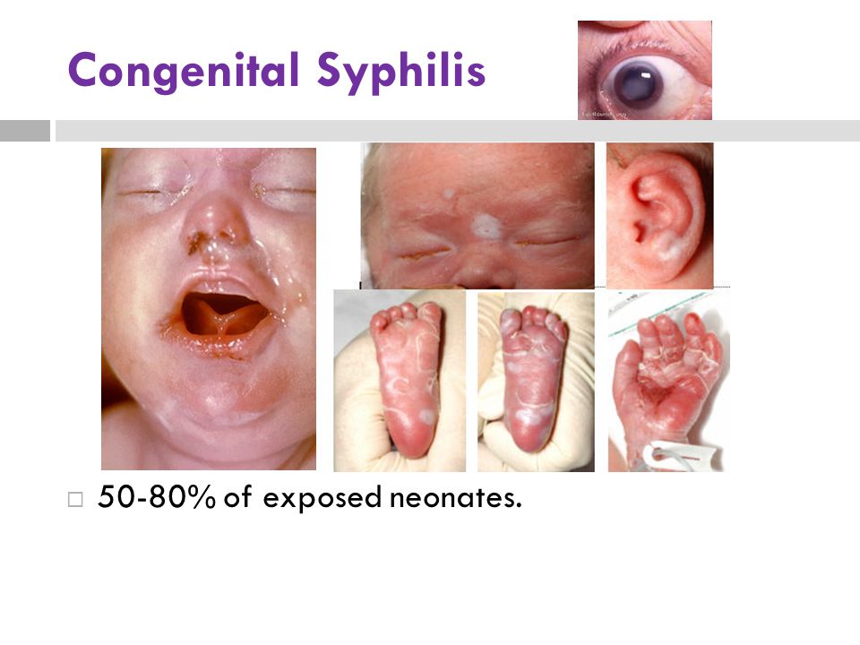 saddle nose syphilis baby
