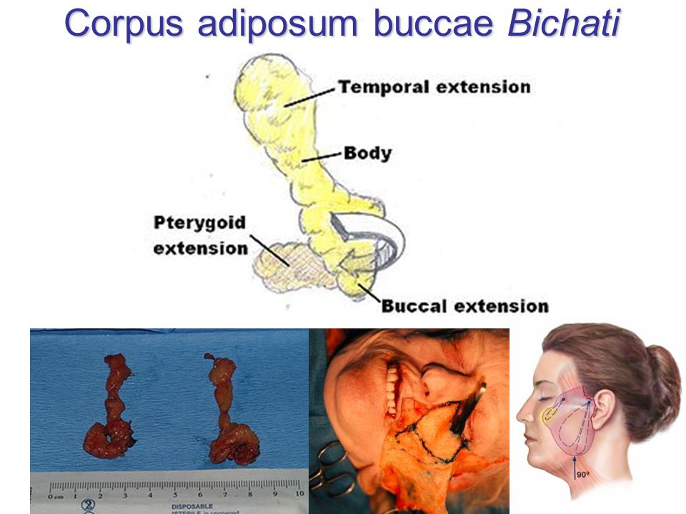 Corpus adiposum buccae Bichati.