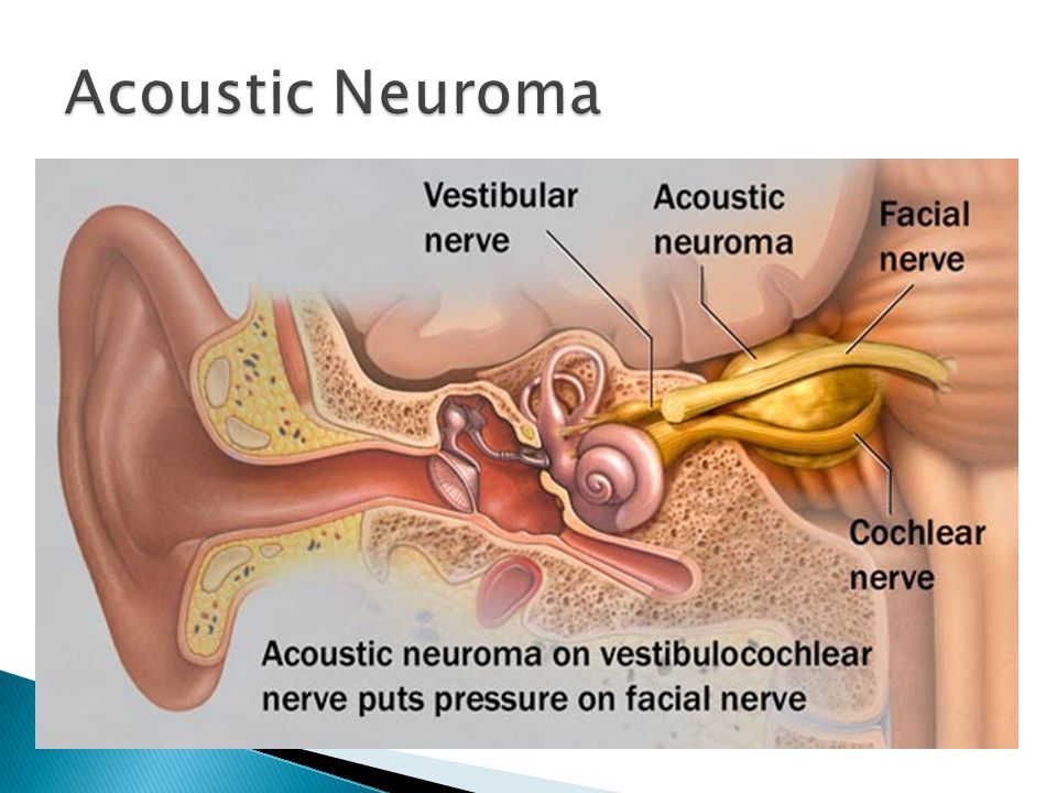 Слуховой нерв в мозге. Функции слухового нерва. Слуховой нерв строение невринома. Невринома вестибулярного нерва.