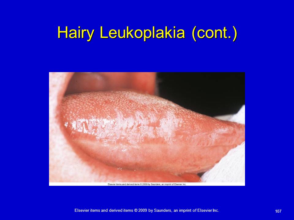 Hairy Leukoplakia (cont.)