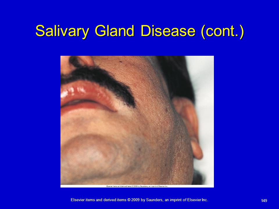 Salivary Gland Disease (cont.)