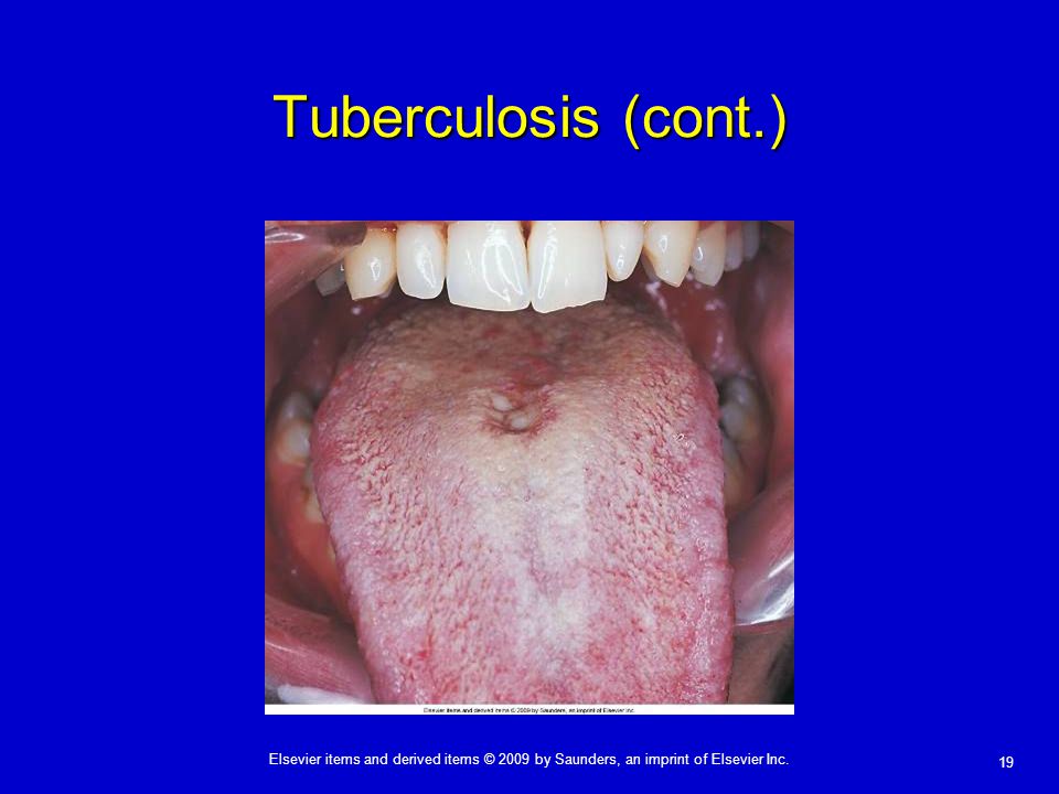 Tuberculosis (cont.)